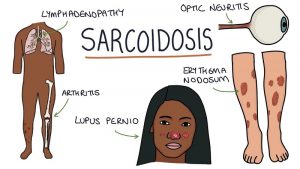 بیماری سارکوئیدوز