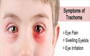 همه چیز درباره بیماری تراخم یا چشم درد مصری (Trachoma) | کافه پزشکی