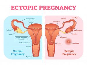 بارداری خارج رحمی (Ectopic Pregnancy) چیست و چگونه اتفاق می افتد ؟ | کافه پزشکی