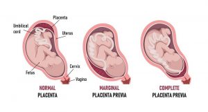 جفت سر راهی (Placenta Previa) ؛ علائم، علل و درمان | کافه پزشکی