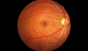 سیر تا پیاز بیماری جداشدگی شبکیه یا پارگی پرده شبکیه (Retinal detachment) | کافه پزشکی