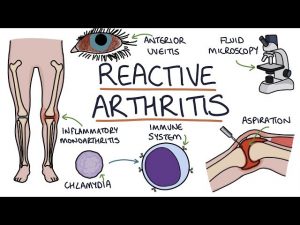 آرتریت واکنشی یا سندروم رایتر ؛ علائم، علل و درمان | کافه پزشکی