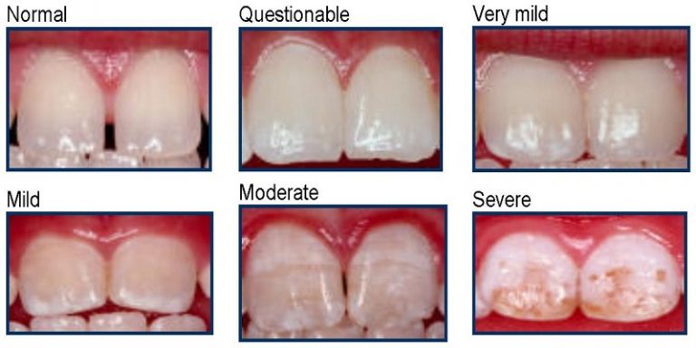 فلوئوروزیس دندانی